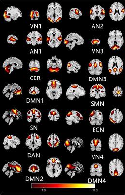 Abnormal Large-Scale Neuronal Network in High Myopia
